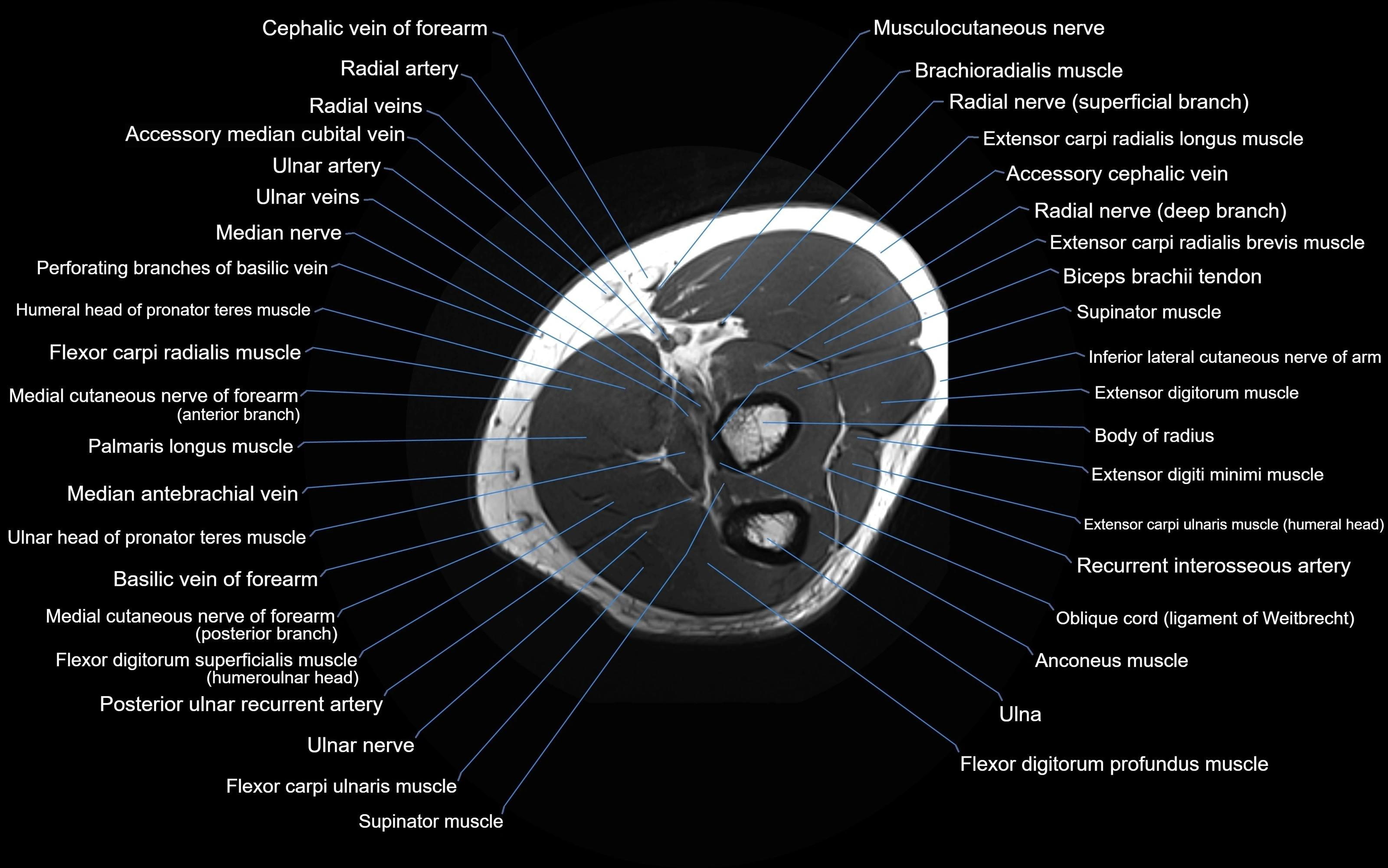 MRI elbow axial cross sectional anatomy 3T  radiology  image-img-00001-00025.webp